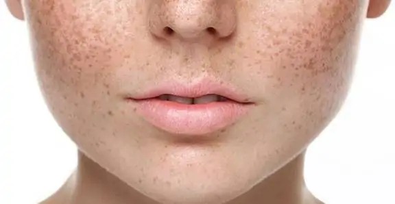 Nám tàn nhang gây ảnh hưởng đến ngoại hình và sự tự tin của nhiều người