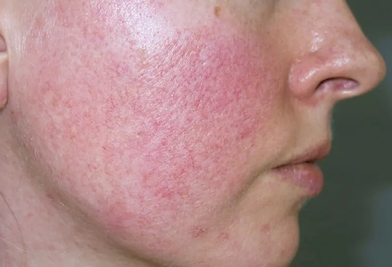 Da thường bị đỏ sau khi peel 