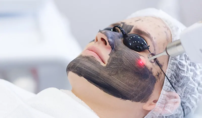 Peel da laser là phương pháp điều trị sẹo rỗ được ưa chuộng vì hiệu quả cao