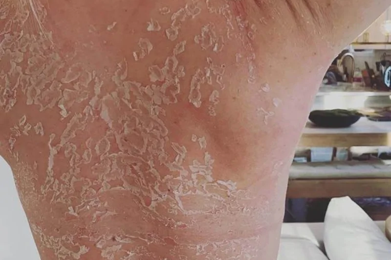 lop te bao chet o lung bi loai bo