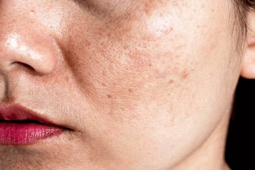 Nám thường tập trung ở vùng  gò má và gây mất thẩm mỹ đối với nhiều người