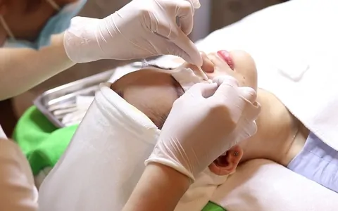 Peel da là phương pháp giúp cải thiện da dầu mụn