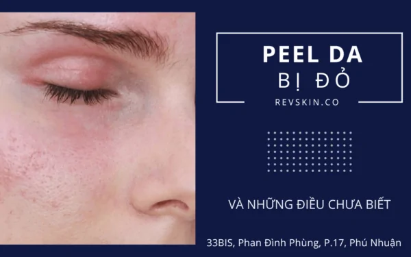Peel da bị đỏ