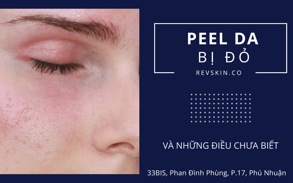 Peel da bị đỏ