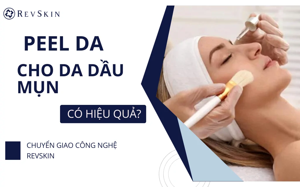 Peel da cho da dầu mụn