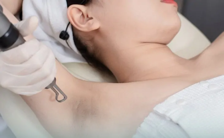 Công nghệ trị thâm nách bằng laser mang lại hiệu quả cao