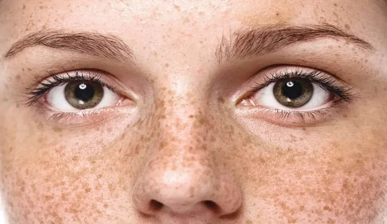 Nám tàn nhang gây ảnh hưởng lớn đến ngoại hình của nhiều người