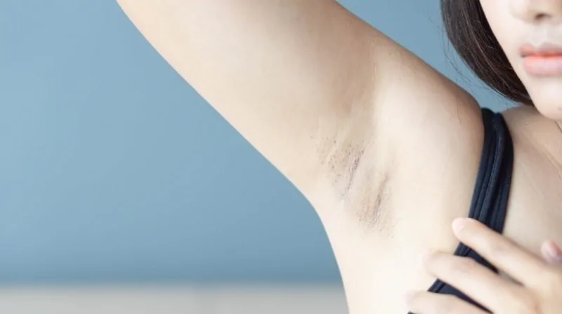 Thâm nách gây ảnh hưởng đến sự tự  tin của nhiều người