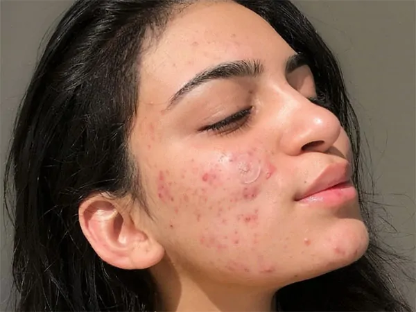 Mụn có thể gây ảnh hưởng đến ngoại hình của mọi người và cứ tái đi tái lại nhiều lần