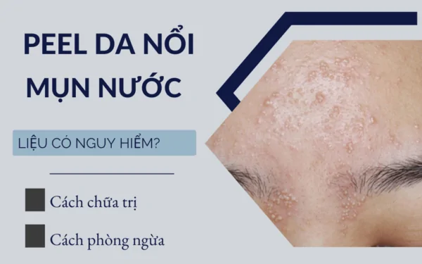 peel da nổi mụn nước