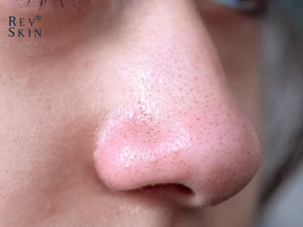 7 cach danh bay mun o mui hieu qua 1