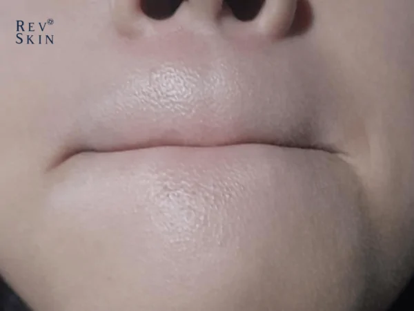 top 10 cach danh bay mun cam o cam nhanh gon 1