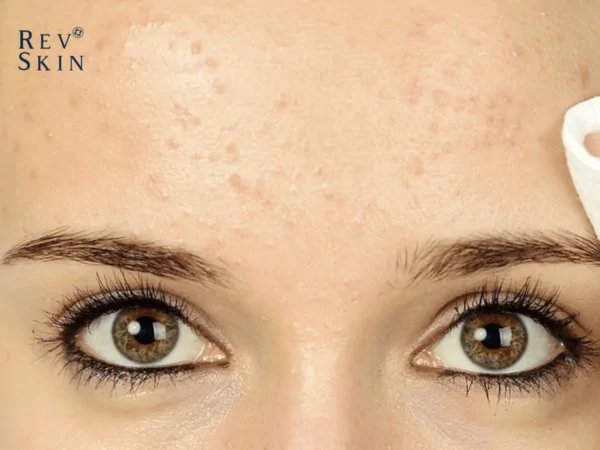 4 phuong phap tri mun an o tran nhanh chong 1