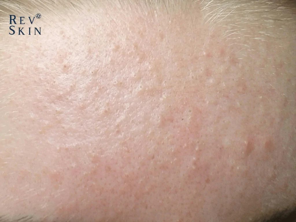 4 phuong phap tri mun an o tran nhanh chong