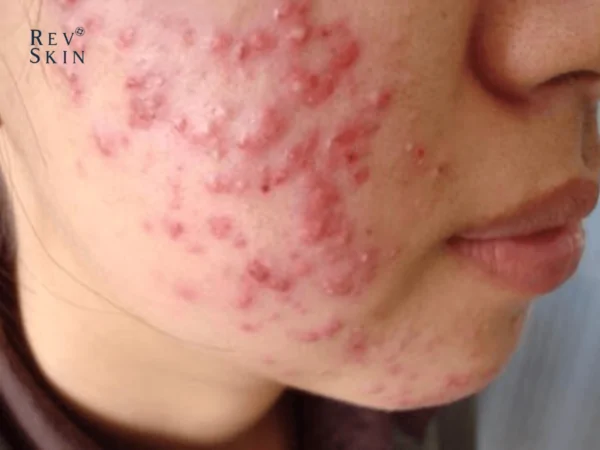 4 tips ngan ngua mun boc o ma 1