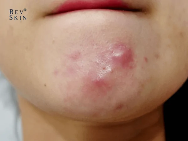 4 tips ngan ngua mun boc o ma 2