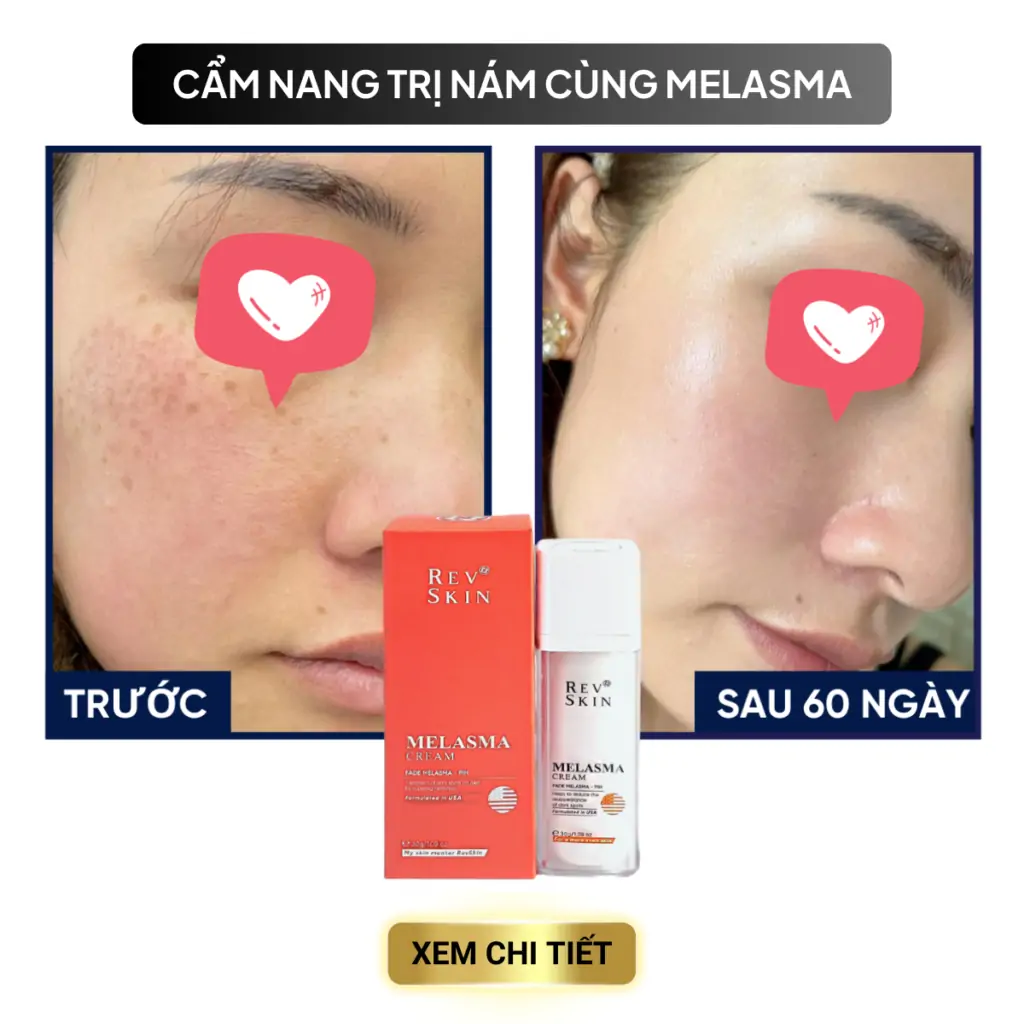 cac van de trong dieu tri mun 10