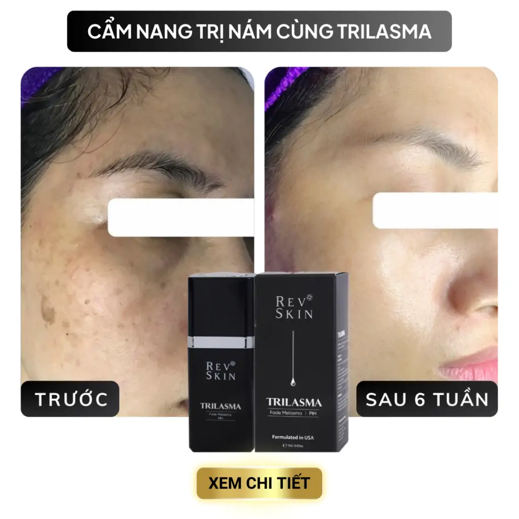 cac van de trong dieu tri mun 11