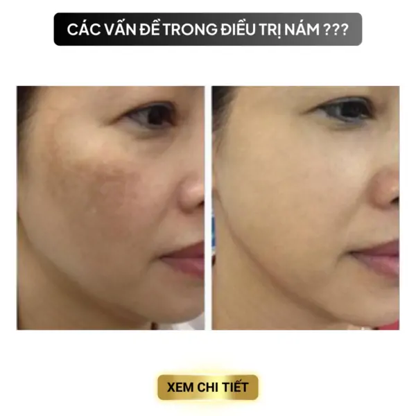 cac van de trong dieu tri mun 12