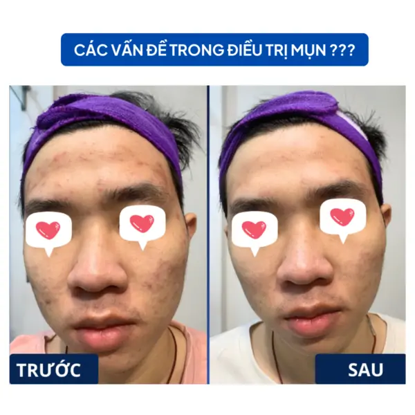 cac van de trong dieu tri mun