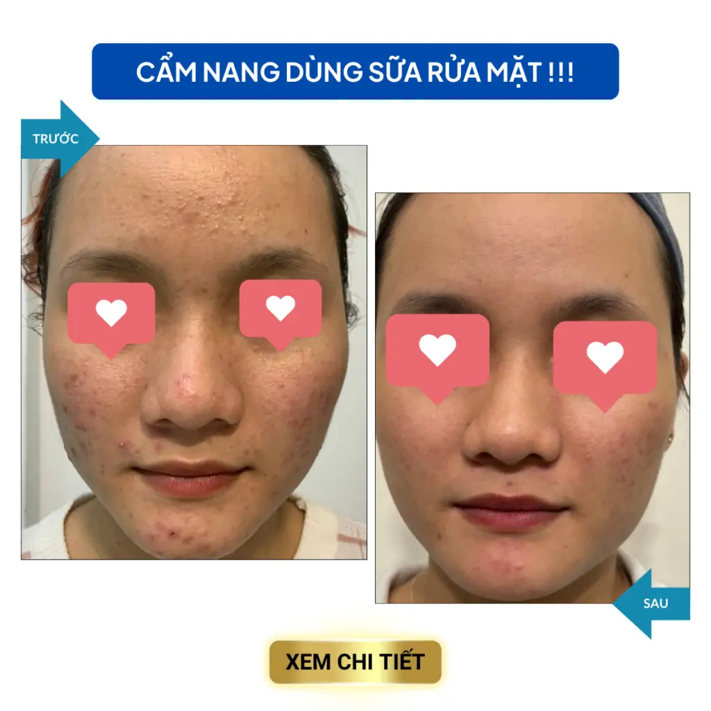 cac van de trong dieu tri mun 7 1