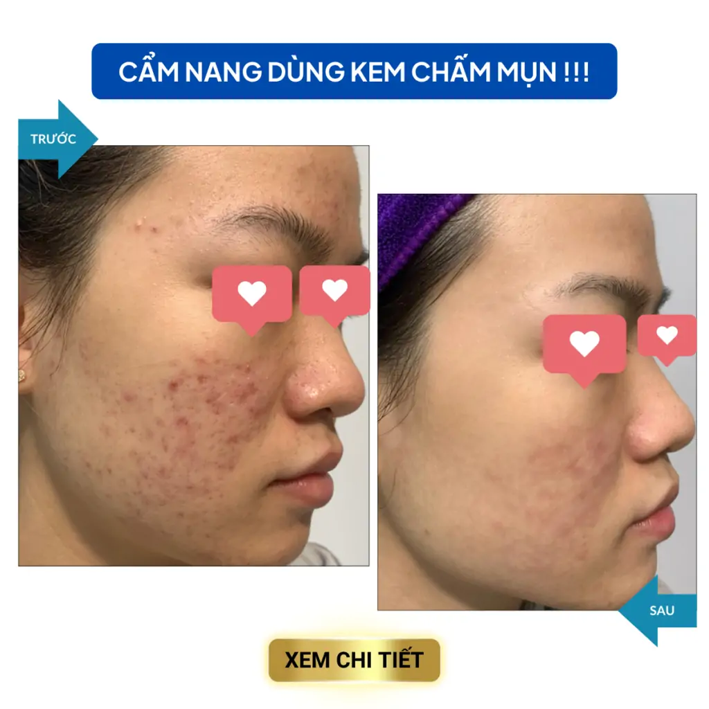 cac van de trong dieu tri mun 8