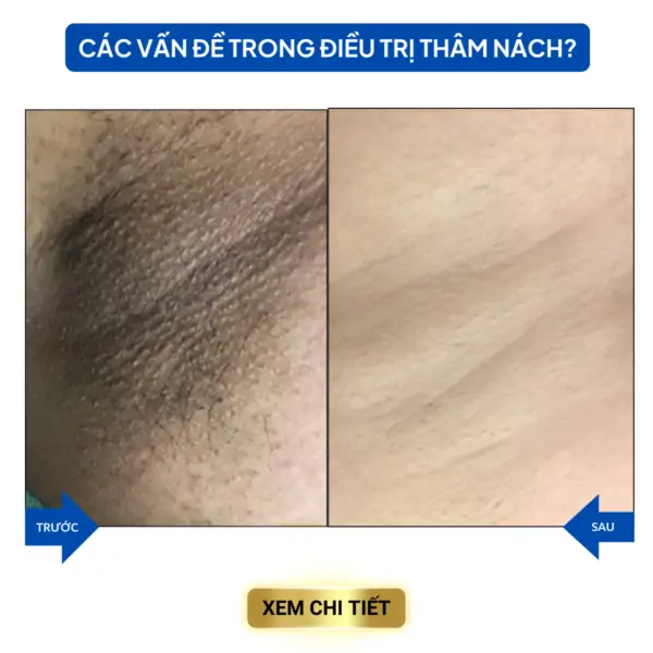 cac van de trong dieu tri mun 9 1