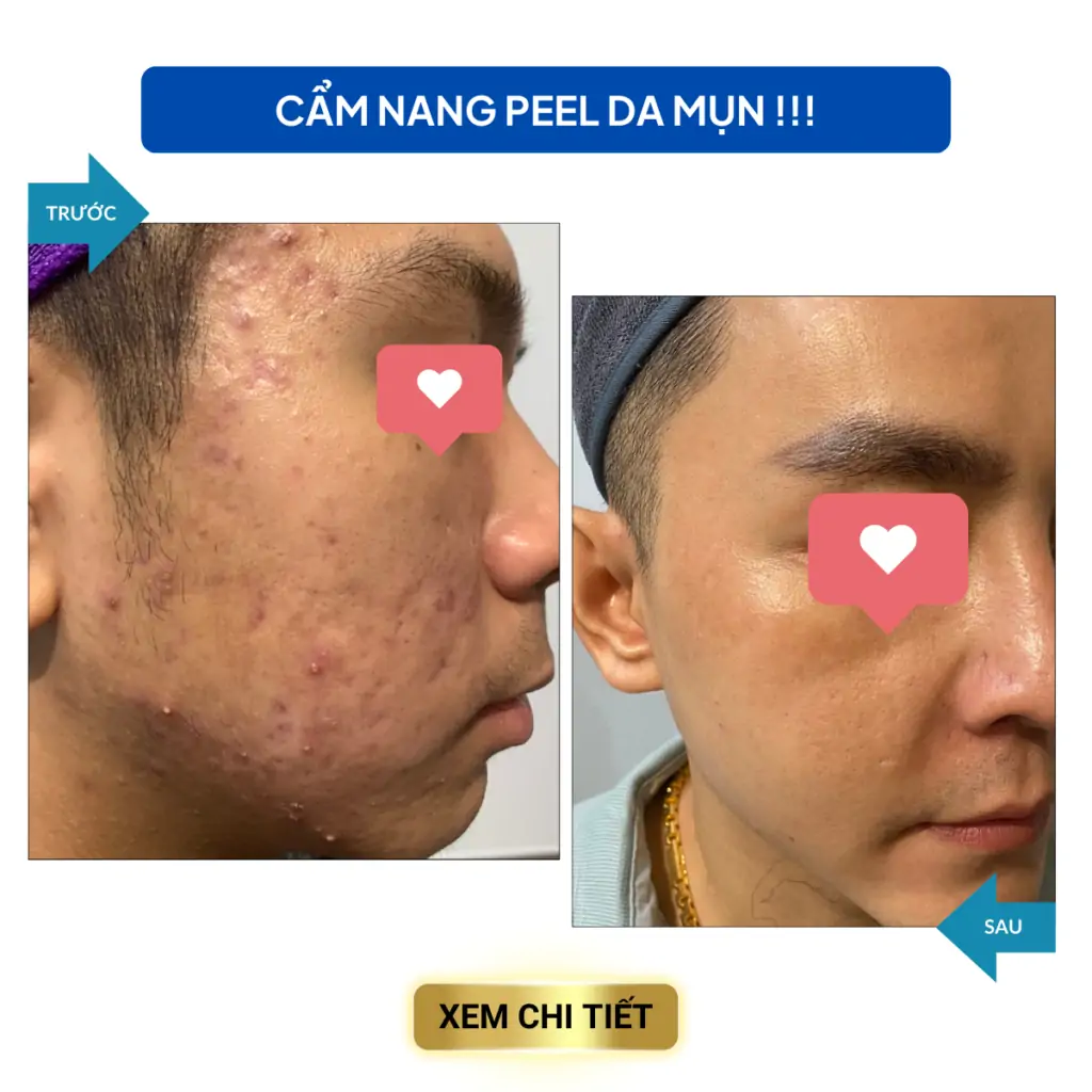 cac van de trong dieu tri mun 9