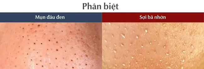 phan biet mun dau den va soi ba nhon banner