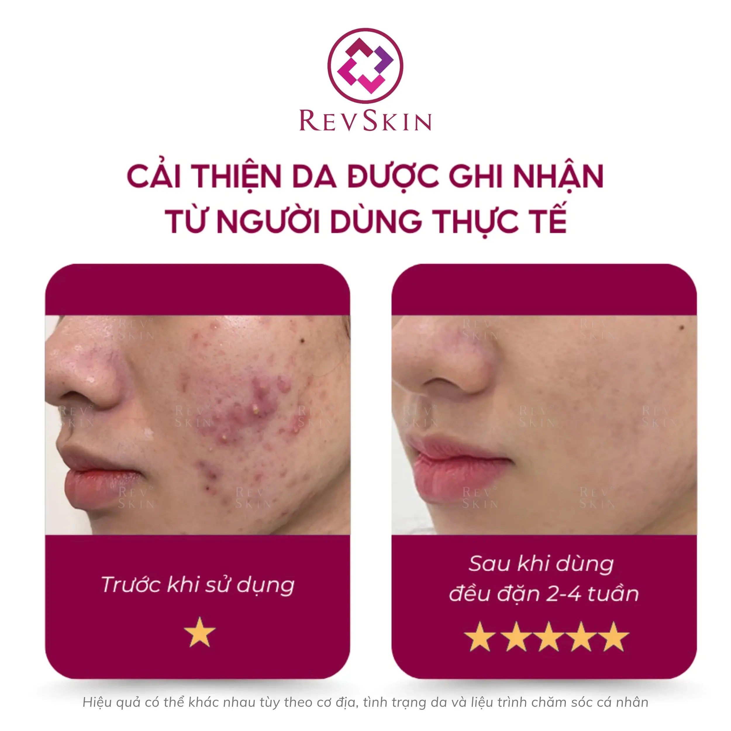 revskin blemish clear cream fb1