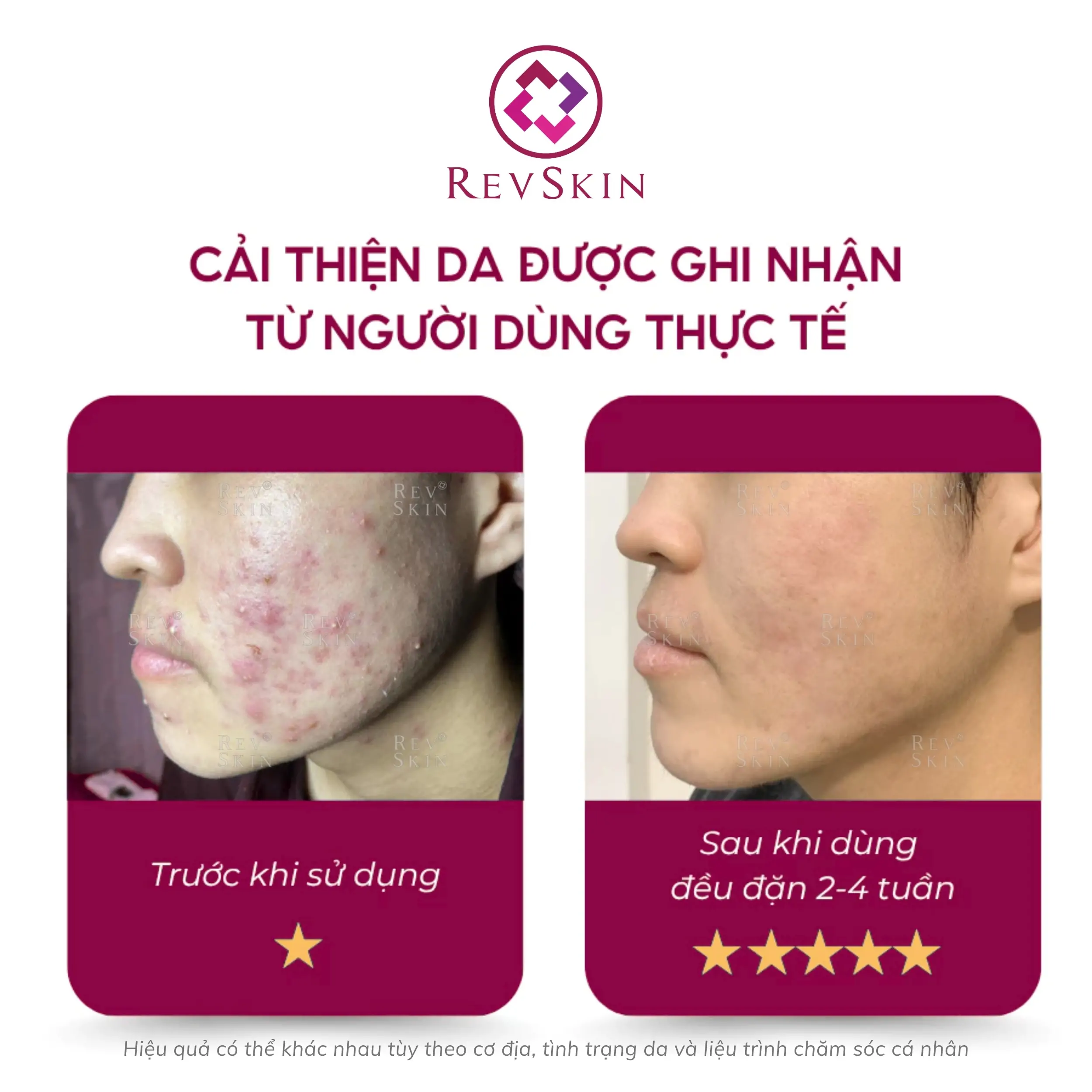 revskin blemish clear cream fb2 1