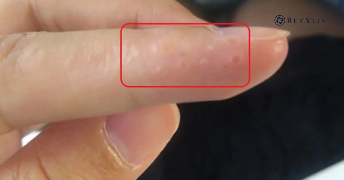 Bị mụn nước là gì