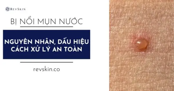 Bị nổi mụn nước ở da