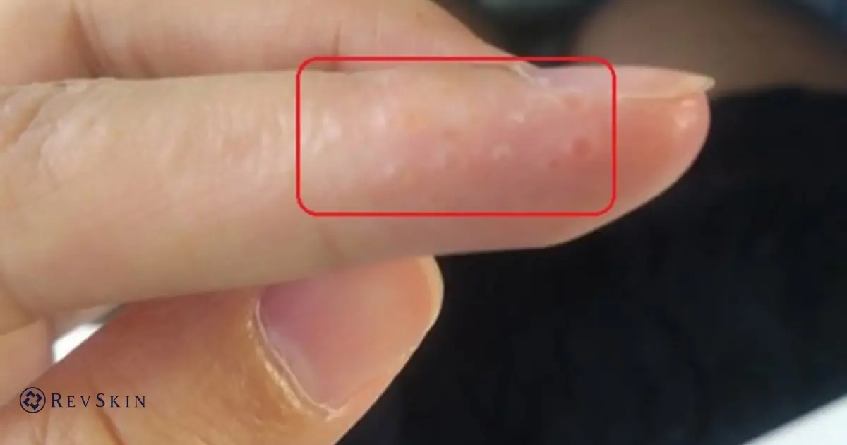 Các laoij mụn ở tay