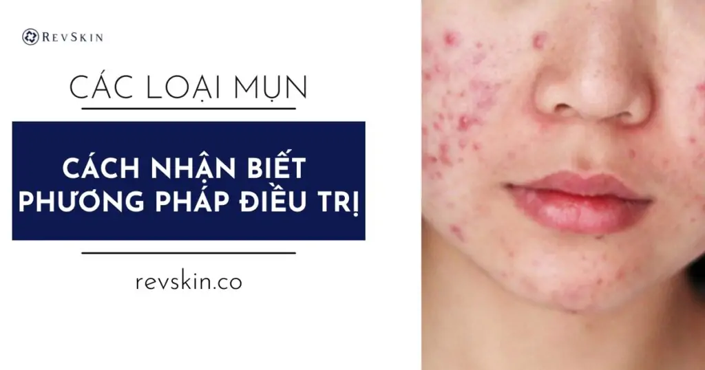 Các loại mụn thường gặp
