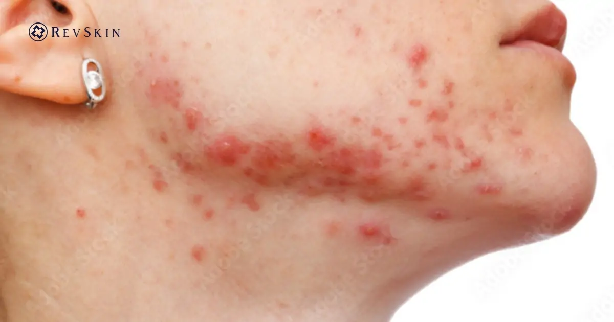 Cải thiện tình trạng mụn ở cầm