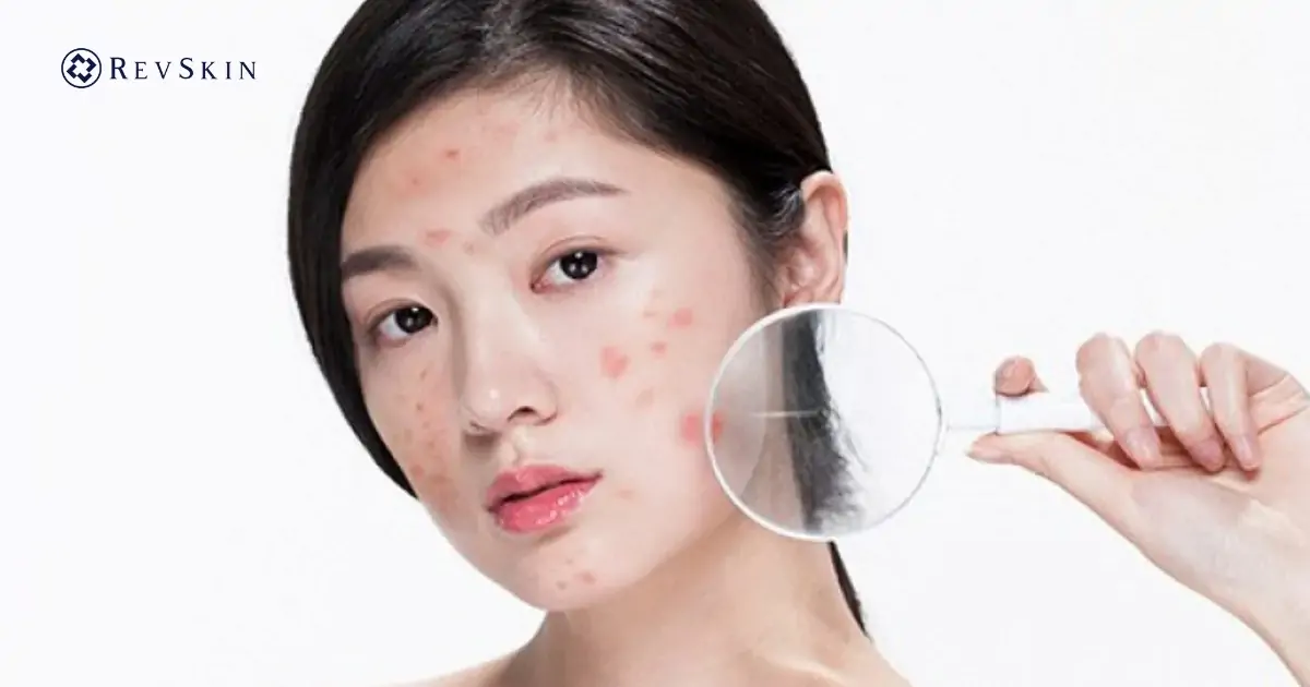 Điều trị mụn theo từng mức độ