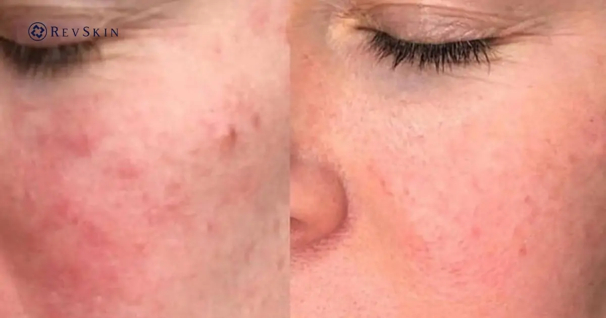 Lưu ý sau buổi liệu trình PRP