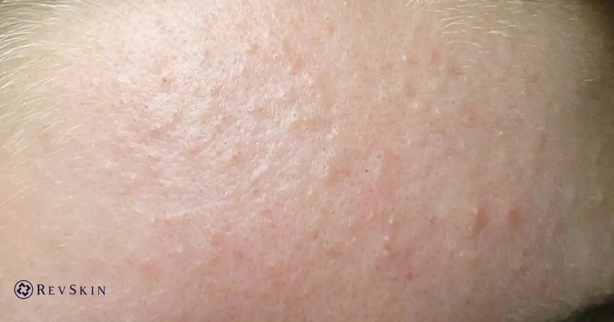 Mụn ẩn dưới da