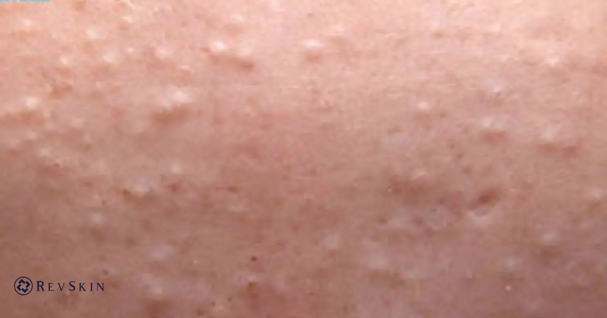 Mụn đầu trắng