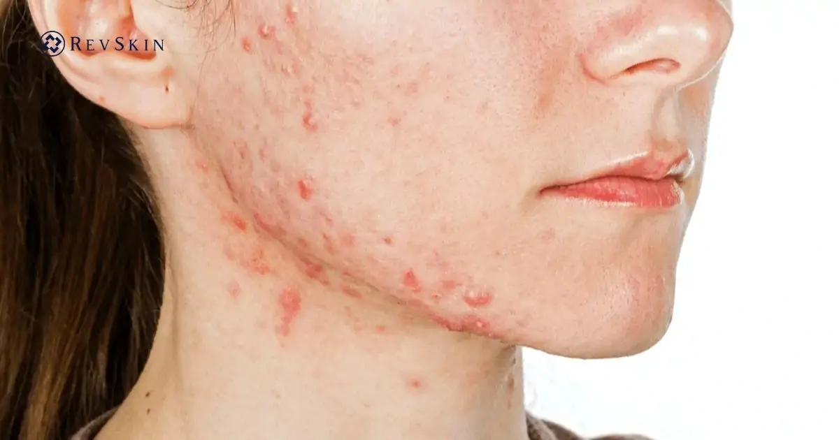 Nguyên nhân gây mụn ở cầm