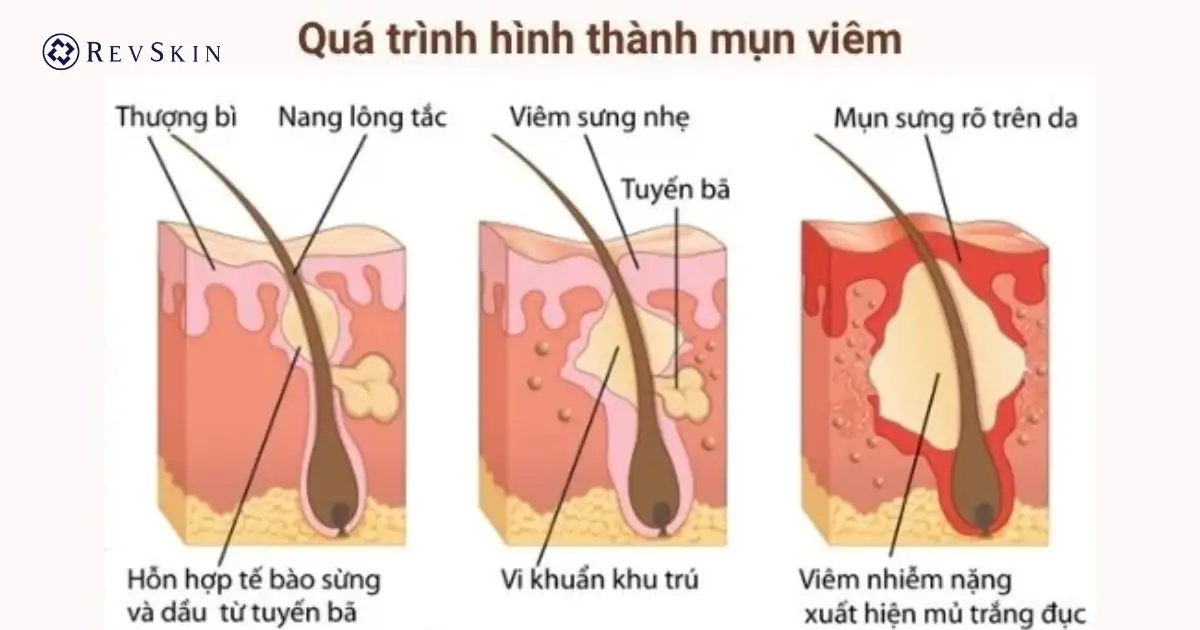 Nguyên nhân hình thành mụn viêm