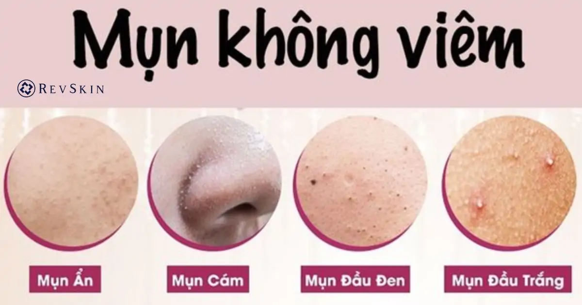 Nguyên nhân khiến bị nổi mụn