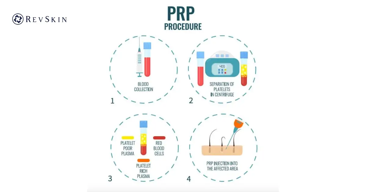 Phác đồ PRP trẻ hóa da chuẩn hiện nay 