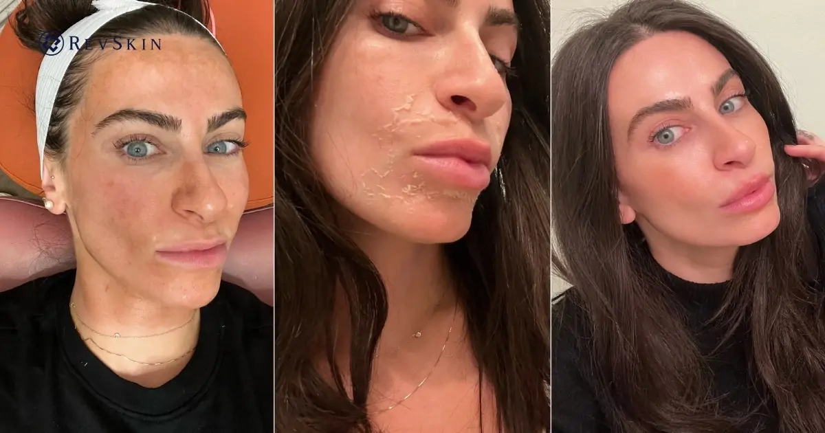 Phác đồ trị thâm bằng peel