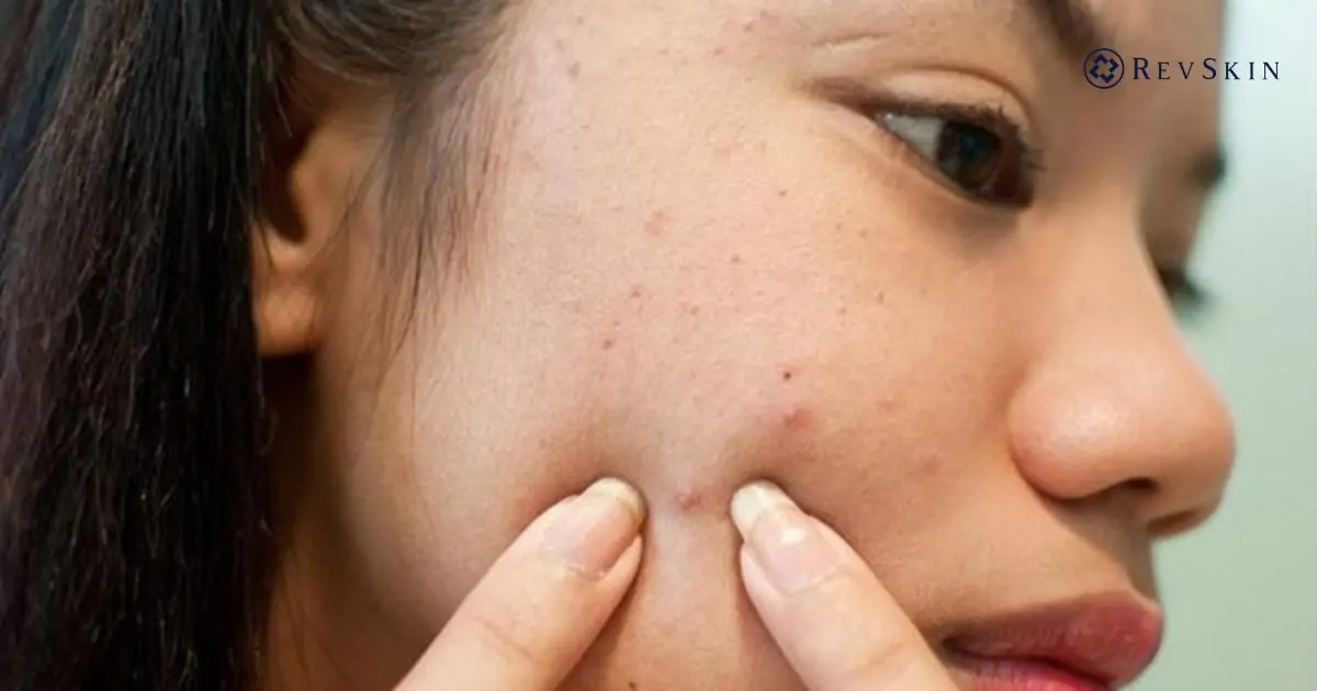 Sai lầm phổ biến khi điều trị mụn