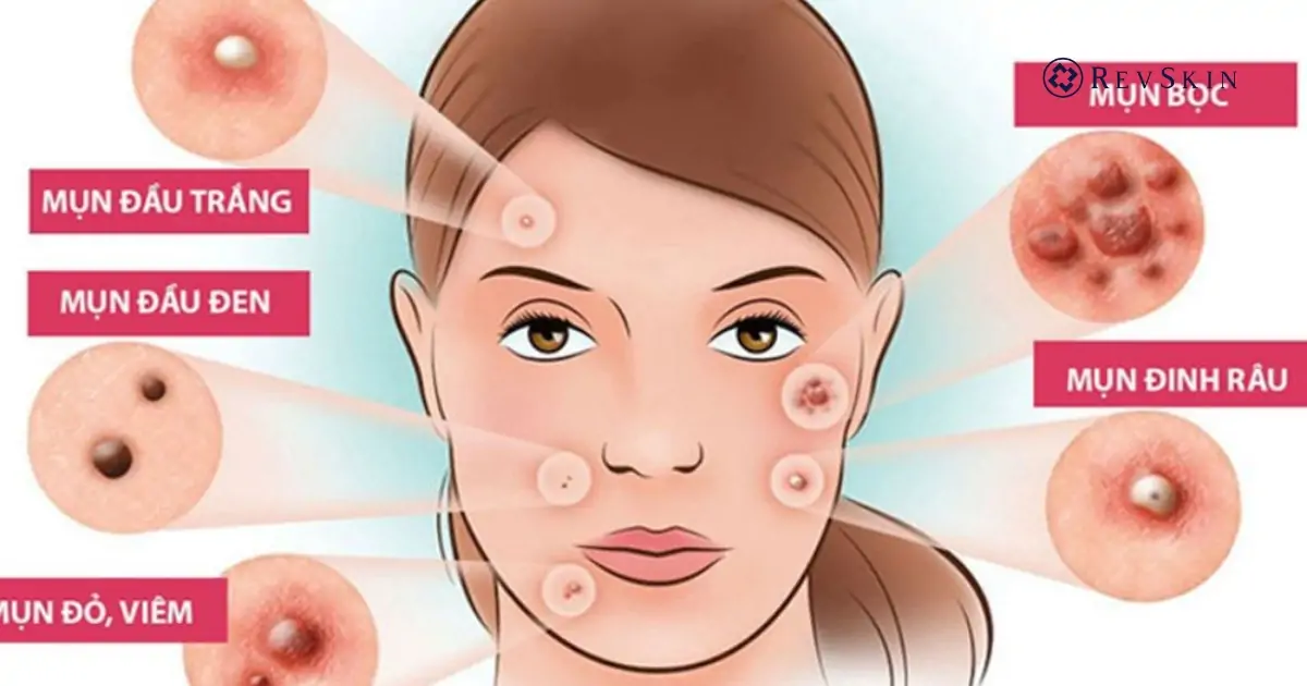 Vì sao cần điều trị mụn đúng cách